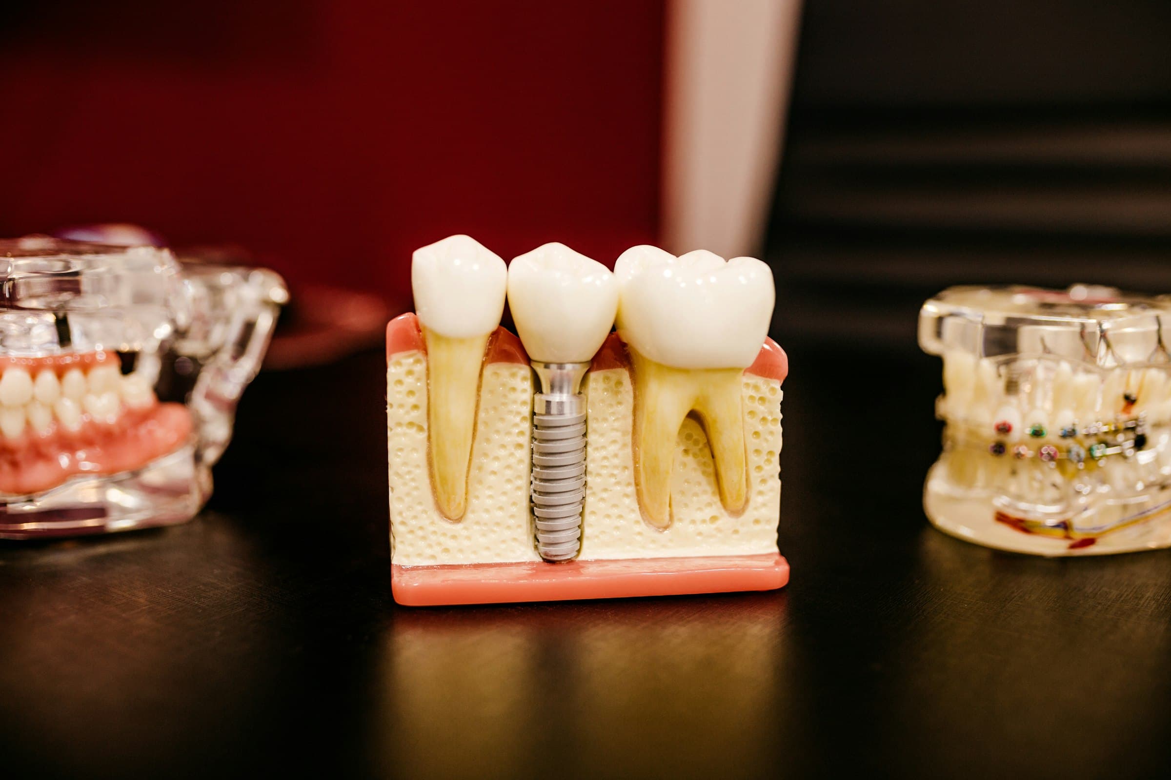 Tooth Extraction