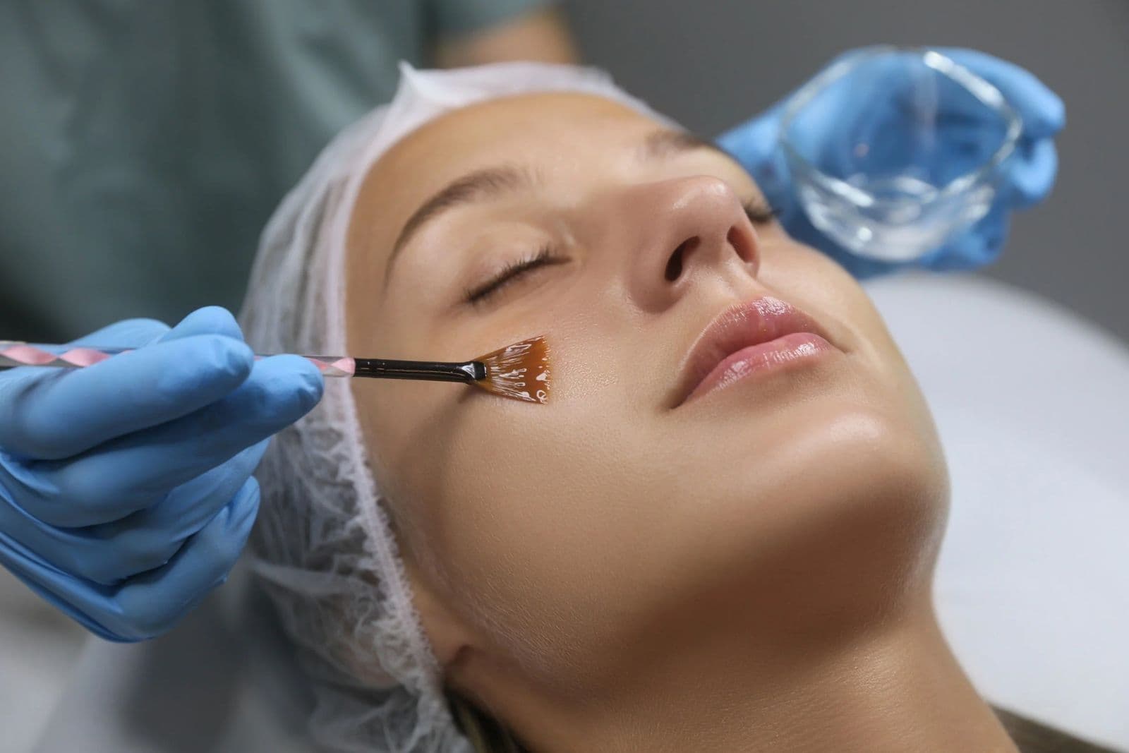 Chemical Peel in Dubai